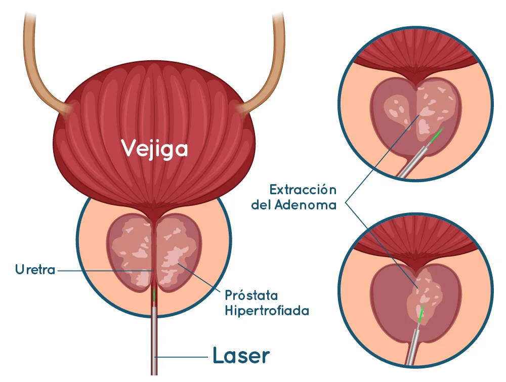 bg-HBP-holep-Dr-Rodrigo-Ledezma