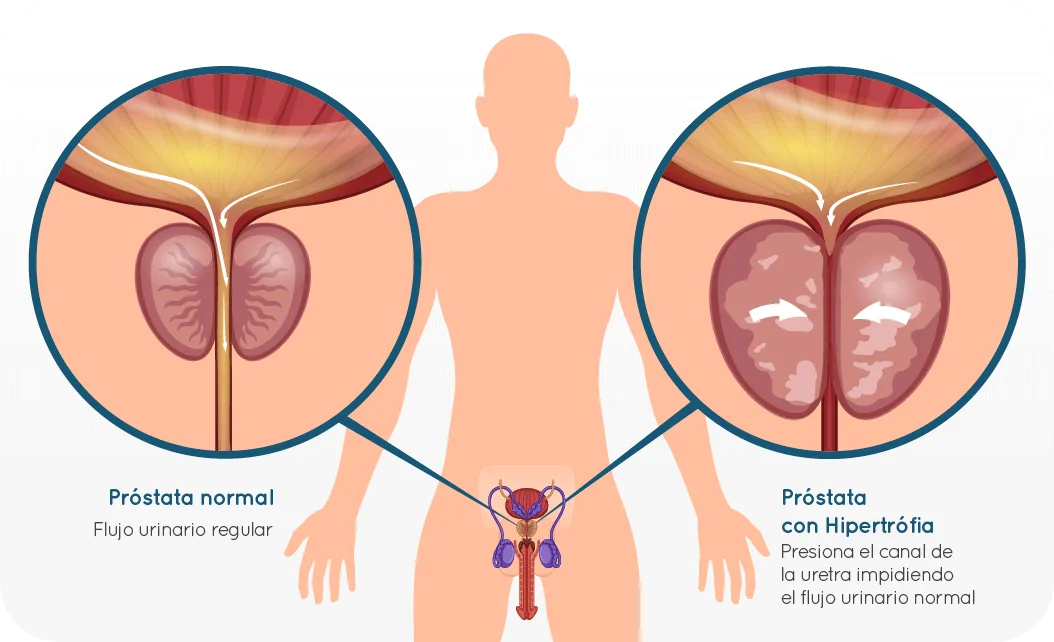 icon-HBP-comparativa-Dr-Rodrigo-Ledezma