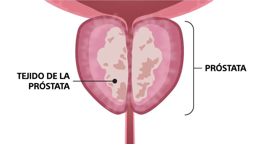 terapia-vapor-antes
