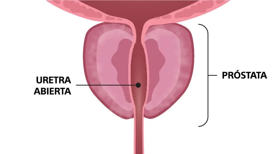 terapia-vapor-despues